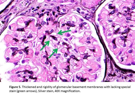 spike and dome appearance kidney|Membranous Nephropathy (MN) .